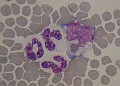 erytrophagocytose